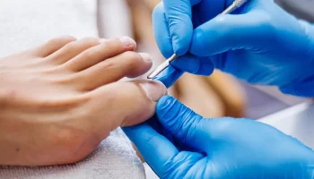 Get Rid of Ingrown Toenail Pain – Trusted Chiropodist in Kanata